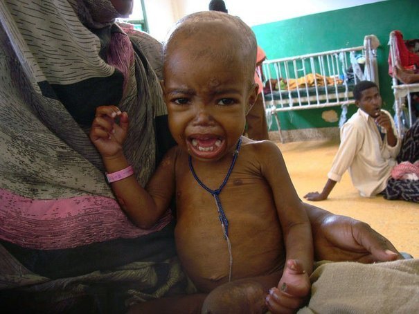 Mali : Augmentation du nombre d’enfants à risque de malnutrition